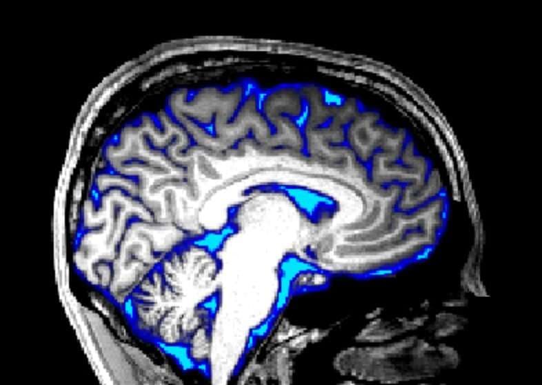 A human brain cross-section with highlighted regions showing fluid dynamics; blue cerebrospinal fluid waves flowing…